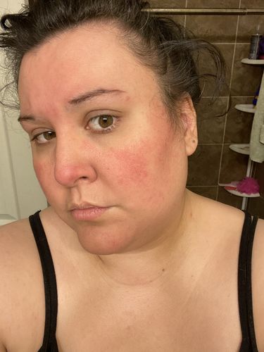 Customer photo review of Rosacea Control