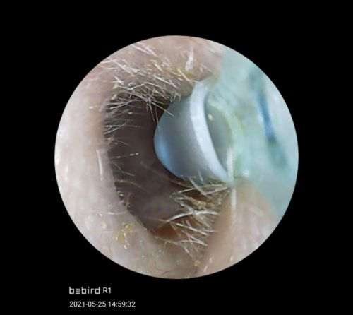 Customer photo review of Ear Wax Removal Tool With Camera For Visual Ear Cleaning