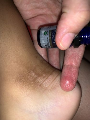 Customer photo review of Eczema Control