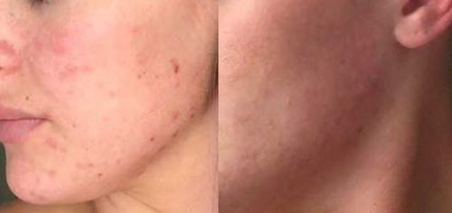 Customer photo review of Salicylsäure BHA 2% 40ml