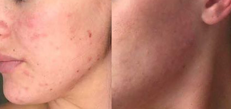 Customer photo review of Salicylsäure BHA 2% 40ml