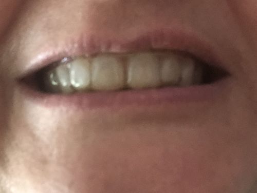 Customer photo review of Night Guard - Yearly Auto renew