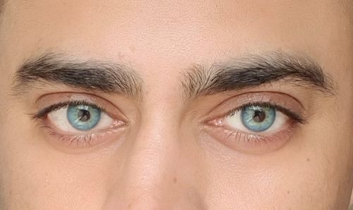 Customer photo review of SL70 Blue Contact Lenses(12 months wear)
