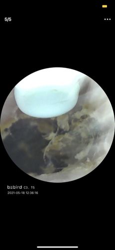 Customer photo review of Bee Gone Wax Ear Cleaner