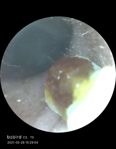 Customer photo review of Bee Gone Wax Ear Cleaner