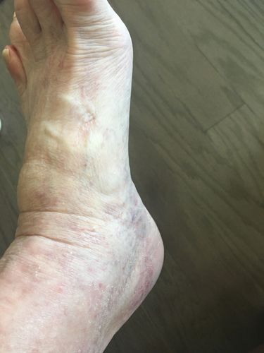 Customer photo review of Eczema Control