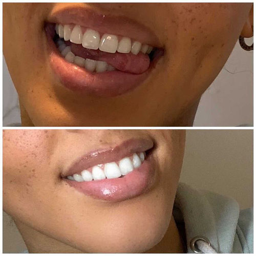 Customer photo review of Teeth Whitening Kit