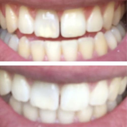 Customer photo review of Teeth Whitening Kit