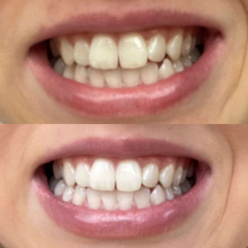 Customer photo review of Teeth Whitening Kit