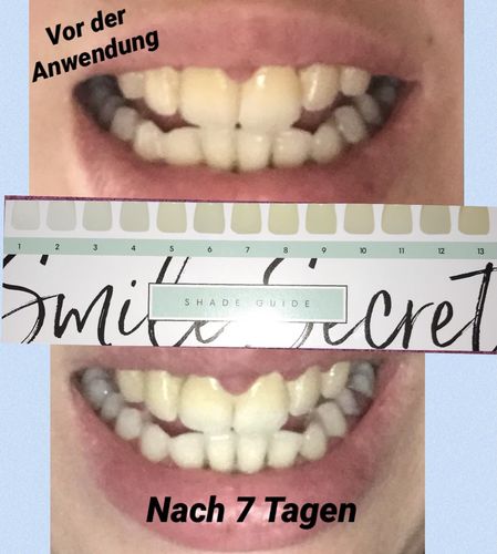 Customer photo review of PAP+ LED Teeth Whitening Kit