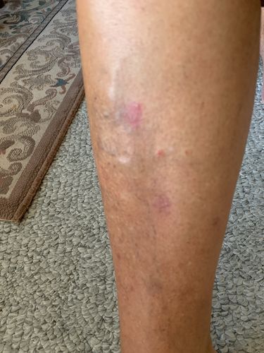 Customer photo review of Psoriasis Relief