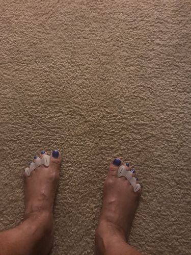 Customer photo review of Correct Toes®