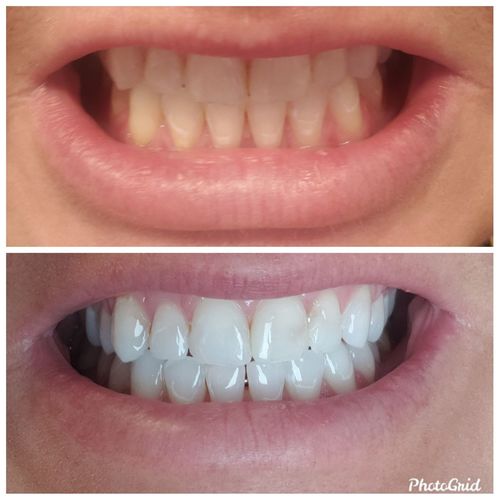 Gleam Reviews 1,110 Reviews gleamteeth.co.uk