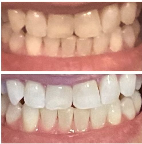 Customer photo review of Teeth Whitening Kit