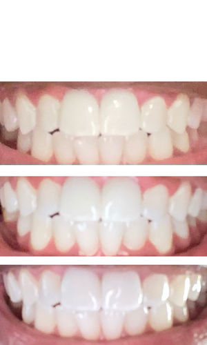 Customer photo review of Teeth Whitening Kit