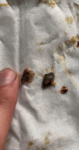 Customer photo review of EarShovel® - The #1 Smartest Ear Wax Removal Tool