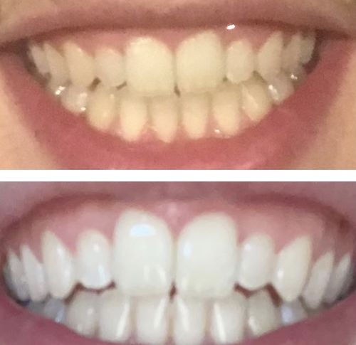 Customer photo review of Teeth Whitening Kit