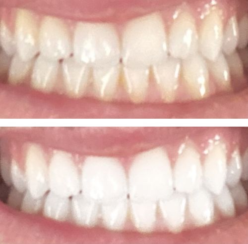 Customer photo review of Teeth Whitening Kit