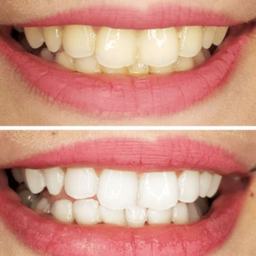 Customer photo review of DM Teeth Whitening