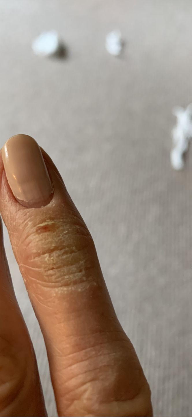 Customer photo review of Bioskin Duo Pack (Free Bioskin Zeoderm)