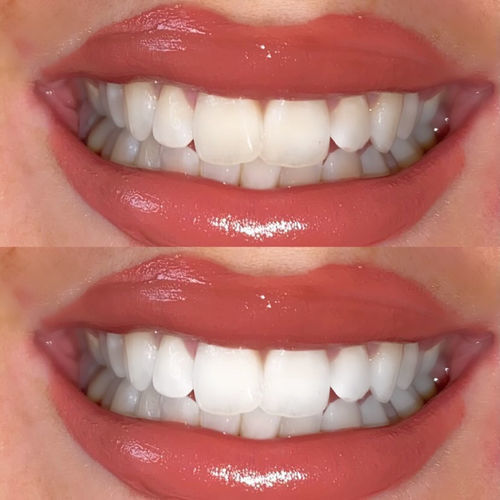 Customer photo review of Teeth Whitening Kit