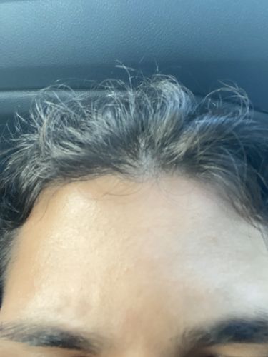 Customer photo review of Varicose Vein Control