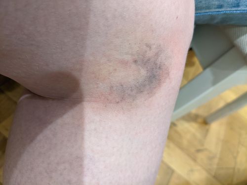 Customer photo review of Ben Nye 3D Special FX Makeup Kit