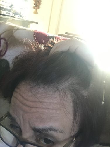 Customer photo review of DHT Blocker Vitamin with Immune Support, Saw Palmetto, and Green Tea