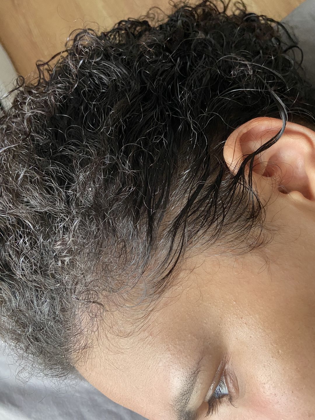 Customer photo review of Psoriasis Honey Scalp Nourishing Kit