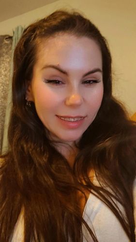 Customer photo review of WrinkleFix: Botox Membership