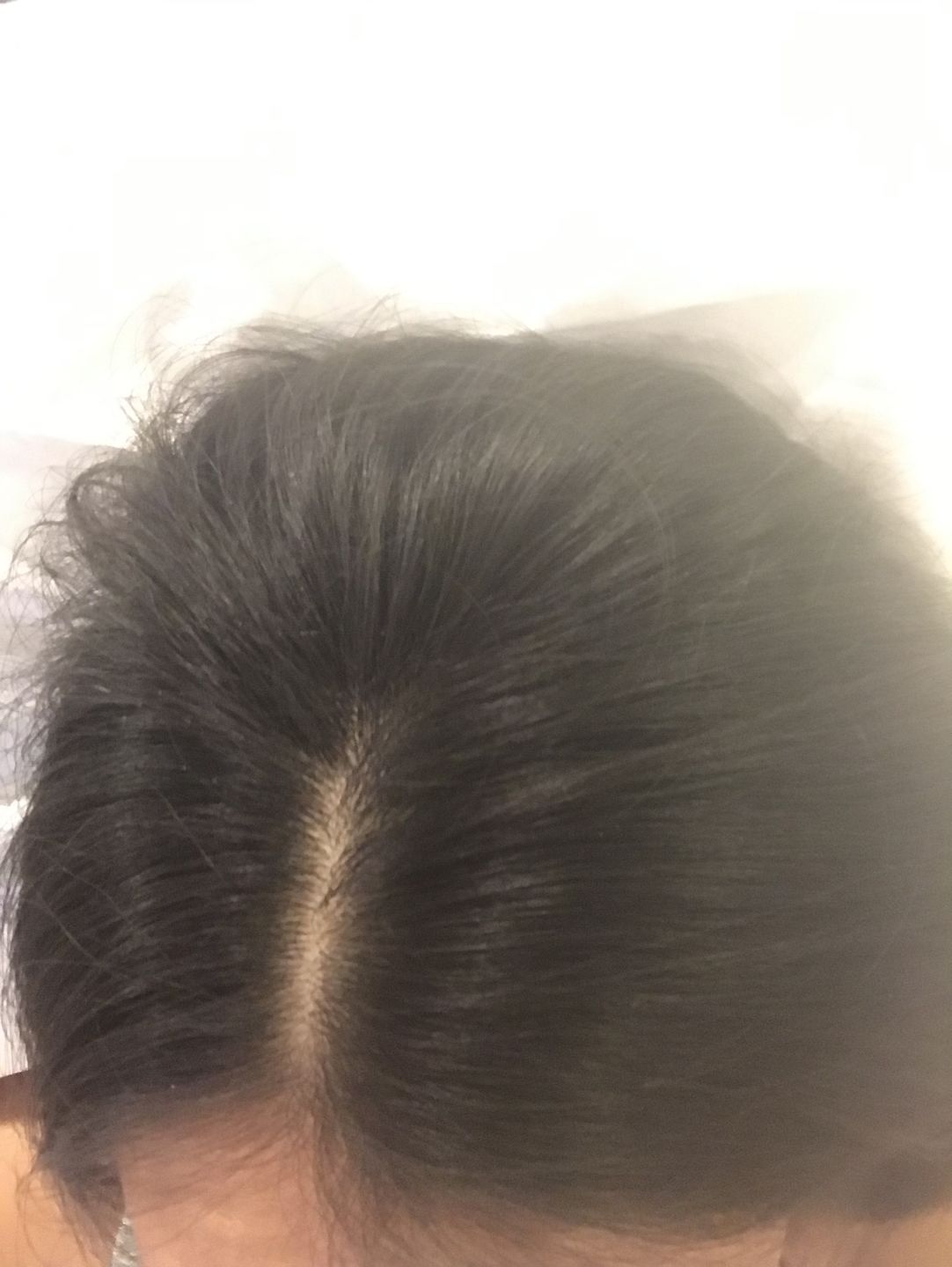 Customer photo review of Psoriasis Honey Scalp Nourishing Kit