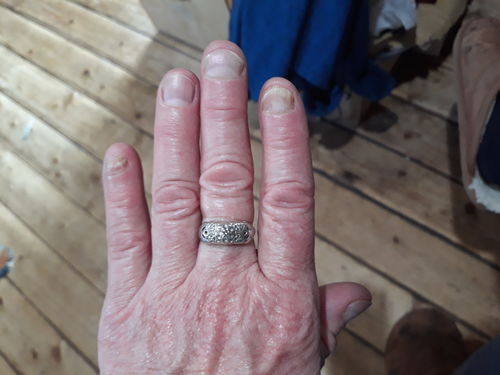 Customer photo review of Nail Fungus Control Extra Strength