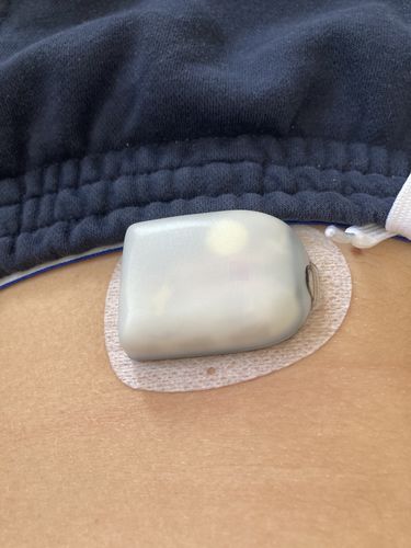 Customer photo review of OMNIPOD DASH: 10 DASH podova