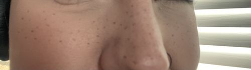 Customer photo review of Freckle Stain