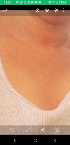 Customer photo review of Omic LightenUp PLUS Lightening Gel - 30ml