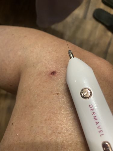 Customer photo review of Dermavel - Solo Kit