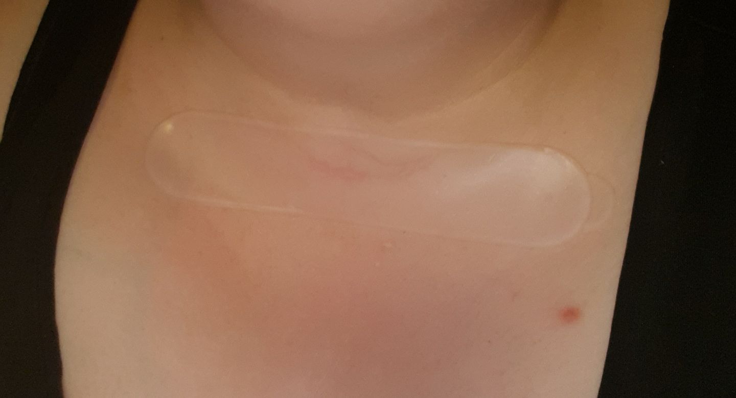 Customer photo review of Narben Pads mit Aloe Vera