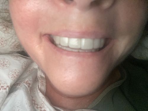 Customer photo review of Night Guard - Yearly