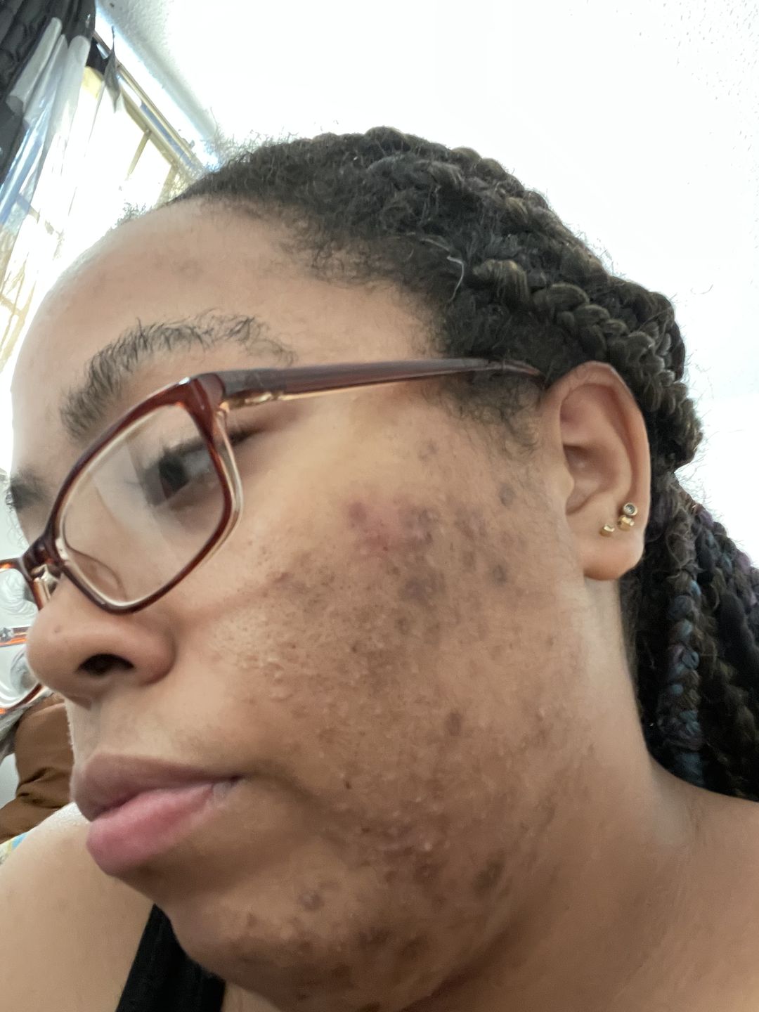 Customer photo review of CALMING ACNE MASK