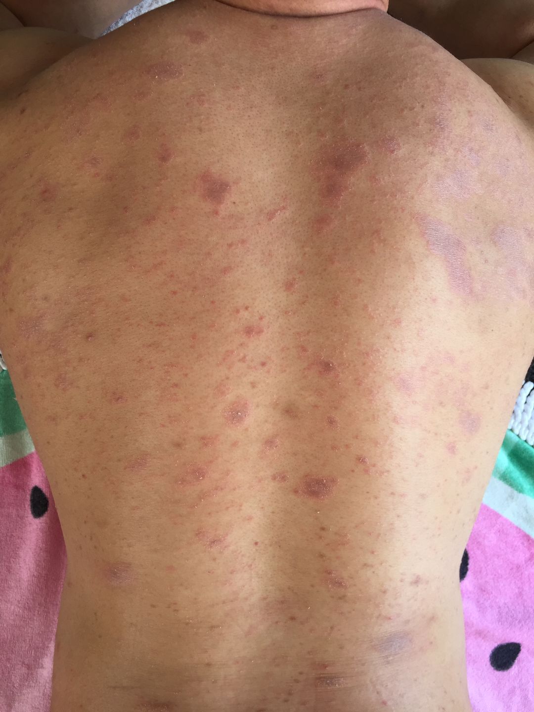 Customer photo review of Eczema Saviour