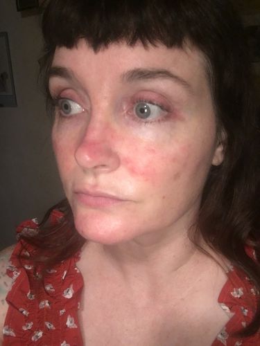 Customer photo review of Rosacea Treatment