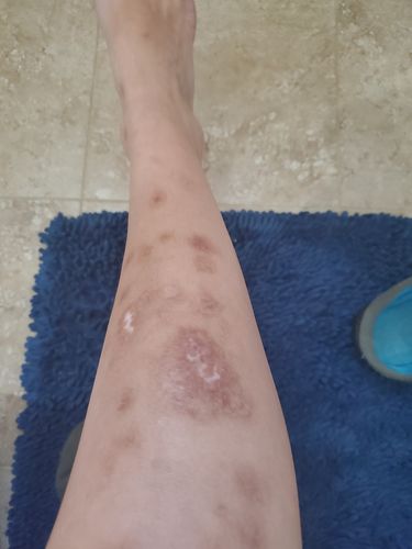 Customer photo review of Eczema Control Remedy