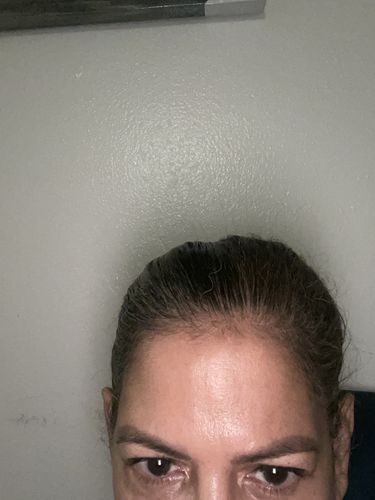 Customer photo review of WrinkleFix: Botox (New Patient Special)