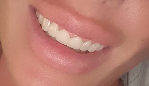 Customer photo review of Tooth-Veneer