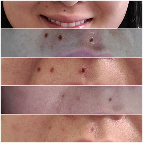 Customer photo review of Dermavel - Solo Kit