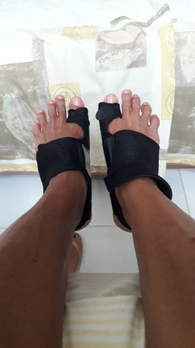 Customer photo review of Attelle orthopédique pour oignon
