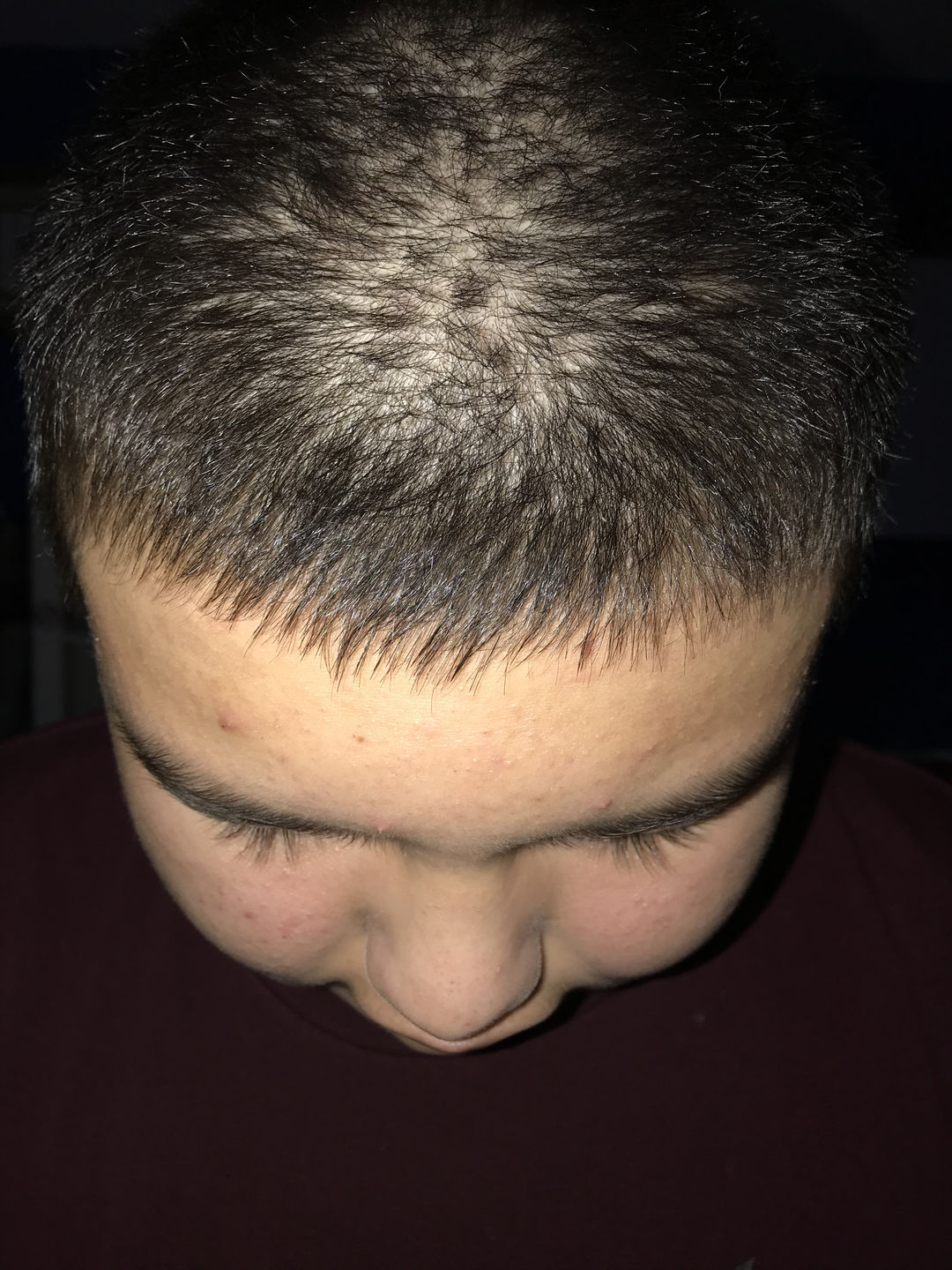 Customer photo review of Psoriasis Honey Scalp Nourishing Kit