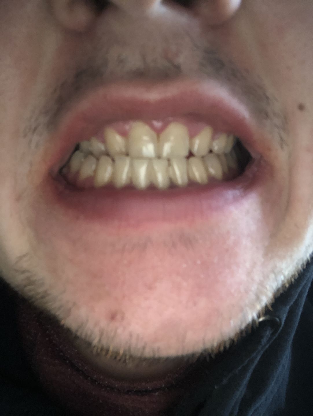 Customer photo review of Whites Sonic LED Electric Toothbrush