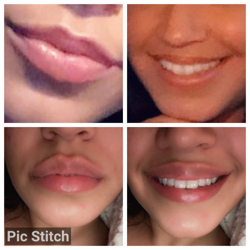 Customer photo review of LipFix: Filler