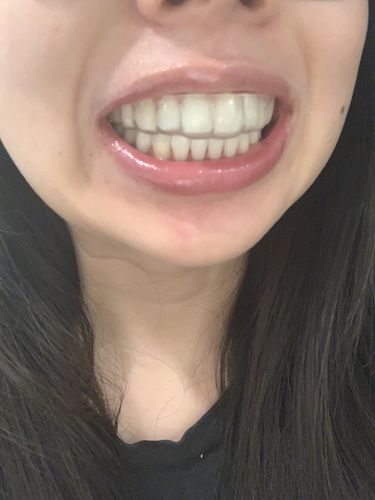 Customer photo review of Night Guard - Yearly Auto renew